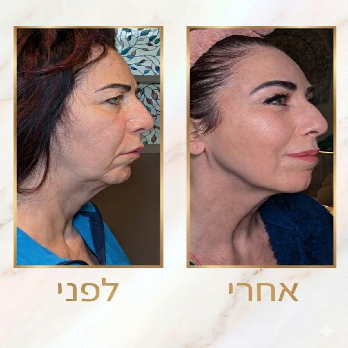 VERDO Dolphin-Lift™ | מכשיר ביוטי-טק ביתי לפיסול ומתיחת קו הלסת סנטר וצוואר