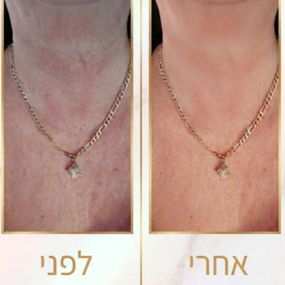 VERDO Dolphin-Lift™ | מכשיר ביוטי-טק ביתי לפיסול ומתיחת קו הלסת סנטר וצוואר