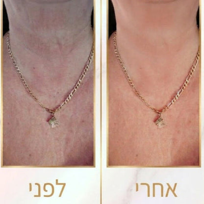 VERDO Dolphin-Lift™ | מכשיר ביוטי-טק ביתי לפיסול ומתיחת קו הלסת סנטר וצוואר